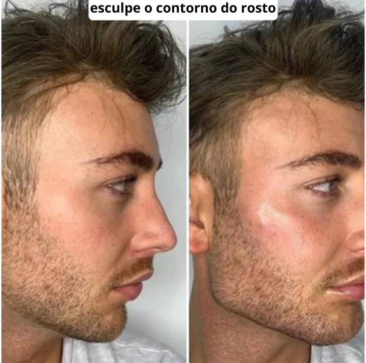 SculptVisage Precisão™